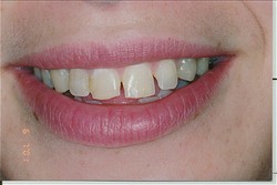 woman's teeth before getting veneers in Brooklyn, NY