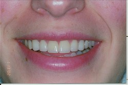 woman's teeth after getting dental veneers done in Brooklyn, NY